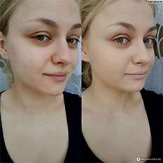 Lamiton до и после использования